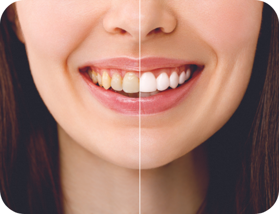blanqueamiento-dental